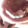 Aspen Dental - Tooth extraction, bridge - Photo 1