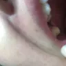 Aspen Dental - Tooth extraction, bridge
