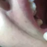 Aspen Dental - Tooth extraction, bridge - Photo 2