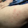Greyhound Lines - bed bugs - Photo 1