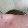 Motel 6 - bed bugs - Photo 3