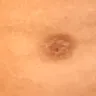 Sono Bello - botched procedure done - Photo 1