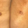 Sono Bello - botched procedure - Photo 2