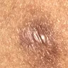 Sono Bello - botched procedure - Photo 3
