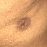 Sono Bello - botched procedure - Photo 5