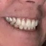 Aspen Dental - Dentures