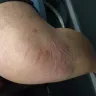 Virgin Australia Airlines - injury caused by virgin australia airline flight attendant. - Photo 1