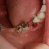 Western Dental Services - pulled tooth