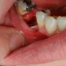 Western Dental Services - pulled tooth