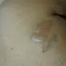 Hartford Hospital - failure to diagnose - Photo 7