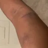 BioLife Plasma Services - Bruises on arm due to employee sticking needle to deep in my arm