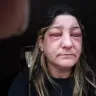 American Medical Association [AMA] - dr wetherbee prescribed bacitracin for my periorbital cellulitis. - Photo 1