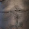 Sono Bello - Liposuction - dr wright - Photo 1