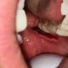 Aspen Dental - Wisdom tooth removal - Photo 1