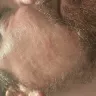 Just For Men - Beard dye severe facial burning