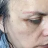 Dr. Renato Calabria - Vertical lift temporal brow lift blepharoplasty