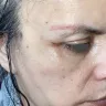 Dr. Renato Calabria - Vertical lift temporal brow lift blepharoplasty - Photo 1