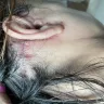 Dr. Renato Calabria - Vertical lift temporal brow lift blepharoplasty - Photo 4
