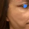 Dr. Renato Calabria - Vertical lift temporal brow lift blepharoplasty - Photo 3