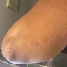 Kampgrounds Of America [KOA] - Bed bugs - Photo 3