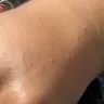 Kampgrounds Of America [KOA] - Bed bugs - Photo 2