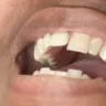 Aspen Dental - Upper and lower