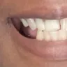 Aspen Dental - Upper and lower