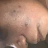 Body Details - Laser on my face - Photo 1