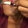 Bright Now! Dental - Gums ripped to top inner lip on the upper left side. - Photo 2