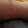 Red Roof Inn - Bed bugs - Photo 1