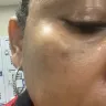 Body Details - Laser spot removal - Photo 1