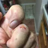 Anheuser-Busch - Broken bottle/cut finger