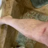 Carnival Cruise Lines - Medical injury on mardi gras ship 3/29/22 suite 9415 - Photo 2