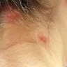 WestJet Airlines - Bed bugs in seat - Photo 1
