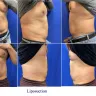 Palm Harbor Plastic Surgery Centre [PHPSC] - lipo surgery