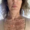 IPL LASER performed by Dr Susan Rabizadeh at Cedars Sinai - Laser Ipl - Photo 4