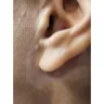 Skin And Vein Center - Botched Mini facelift. Eric Seiger Sterling Heights MI. - Photo 4