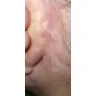 Skin And Vein Center - Botched Mini facelift. Eric Seiger Sterling Heights MI. - Photo 3