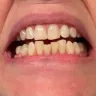 BrightByte - Continued treatment at no additional cost until my teeth are straight.