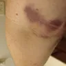 BioLife Plasma Services - Bruised arm because of needle 