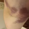 BioLife Plasma Services - Bruised arm because of needle 