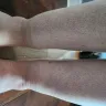 Sono Bello - Liposuction procedure - Photo 1