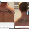 LaserAway Medical Group - Tattoo removal - Photo 1