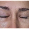 Mayclinik - Deep plane facelift, neck lift, eye and brow lift