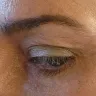 Mayclinik - Deep plane facelift, neck lift, eye and brow lift - Photo 6