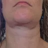 Mayclinik - Deep plane facelift, neck lift, eye and brow lift - Photo 3