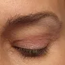 Mayclinik - Deep plane facelift, neck lift, eye and brow lift - Photo 4