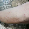 Kampgrounds Of America [KOA] - Flea and mosquito infestation