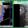 Nexxt Spine - Spinal fusion surgery hardware - Photo 1