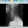 Nexxt Spine - Spinal fusion surgery hardware